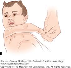 Image result for Floppy Infant