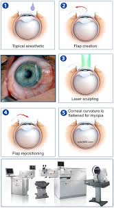 Image result for Refractive Error