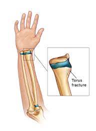 The length of time the cast is worn will vary depending on the severity of the fracture. Buckle Torus Fracture Of An Arm
