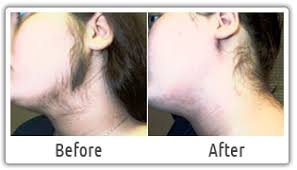 3,000 per session and laser hair removal prices differ as per the size of the area undergoing treatment including the face, bikini, legs and various than a few other factors affect the laser hair removal price. Laser Hair Removal Face Cost Off 52 Online Shopping Site For Fashion Lifestyle
