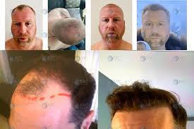 Thank you for visiting capilia orlando. Free Consultation Eliminiate Your Hair Loss Today