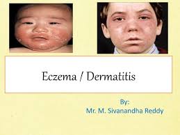 Eczema
