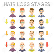 Information Chart Of Hair Loss Stages Types Of Baldness Illustrated