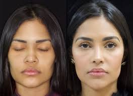 30+ Shocking Transformations: People Who Took Plastic Surgery to the Next  Level