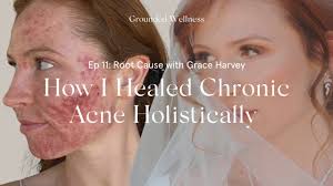 How I Healed Years of Chronic Acne Holistically with Grace Harvey and  Taylor Dukes