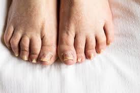 Image result for Onychotillomania feet
