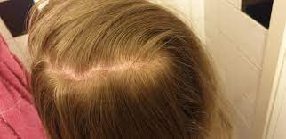 I Have Two Hair Whorls In The Back Of My Head Making A Parting Is It Possible To Tame It Hair Beauty Skin Deals Me Hair Whorl Hair Celebrity Hair Colors