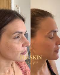 ✨ Just 2 weeks difference, using the right medical grade routine! These  before & after skin analysis images show how quickly the skin can change  when inflammation is properly treated. What you're
