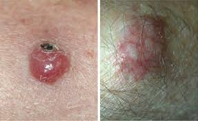 Diagnosis requires microscopic evaluation as the clinical appearance is nonspecific and can mimic a variety of benign and malignant skin lesions. Merkel Cell Carcinoma Warning Signs And Images The Skin Cancer Foundation