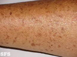 Image result for liver spots on legs