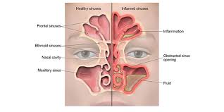 Noses vary considerably in size and shape, mainly as a result of the differences in the nasal cartilages and the depth of the click here for a diagram on the innervation and blood supply of the mucosa of the nasal septum. Sinus Infection Sinusitis Community Antibiotic Use Cdc