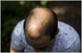 A brain infection is inflammation of the brain or spinal cord and can cause nausea, fever, seizures and more. Hair Loss Spiritual Cause Meaning And Healing Insight State
