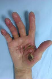 Find causes and treatments of your physical symptoms.for your health. Caustic Skin Burn Caused By Sodium Hydroxide Bmj Case Reports