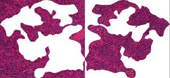 Photodynamic therapy is most often used as a local treatment, which means it treats a specific part of the body. Dktk Immune Cells Predict Recovery Rates In Breast Cancer
