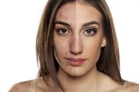 Also, the primary stress hormone, cortisol, can also trigger testosterone production. Adult Hormonal Acne Geria Aanand Geriadermatology Com