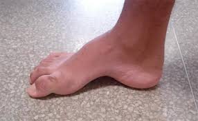 Image result for Onychogryphosis feet