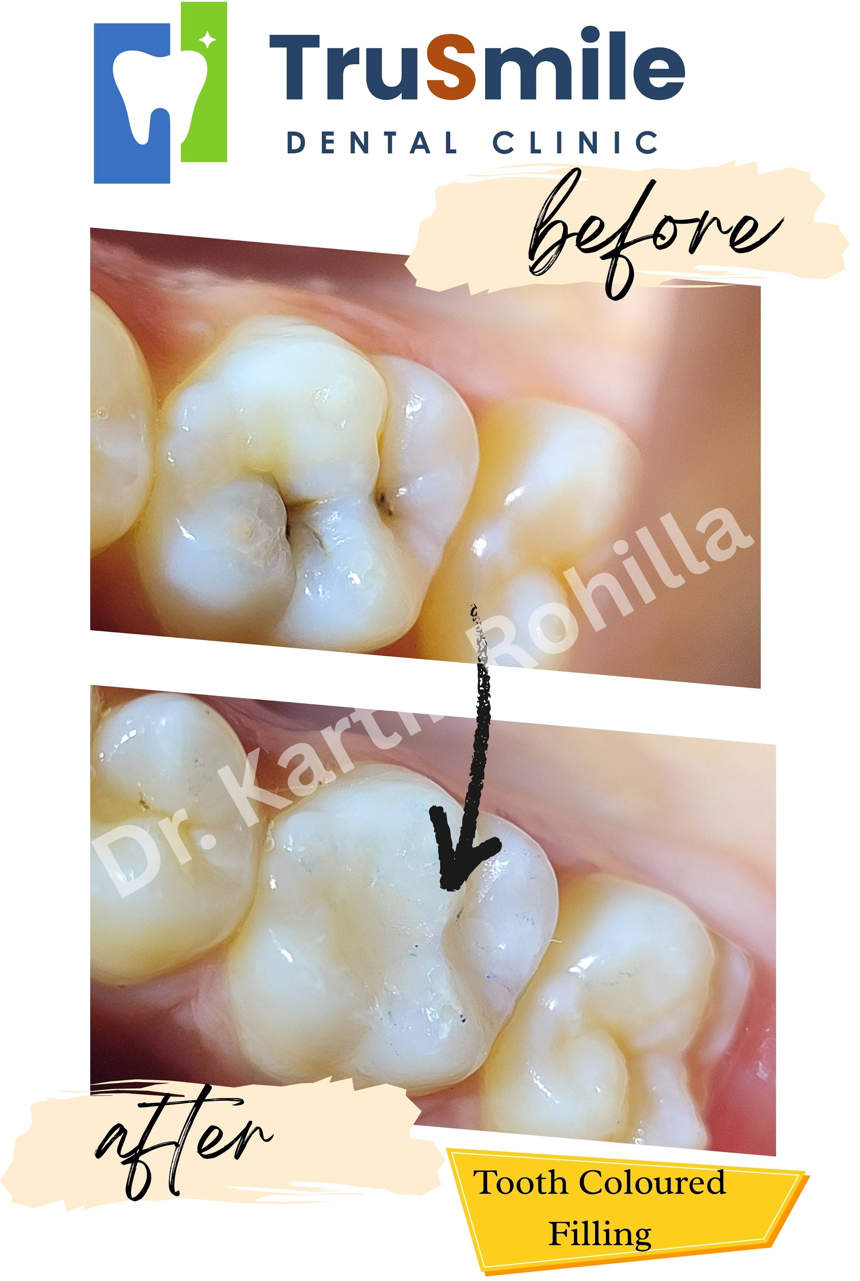 Dental Restoration product image