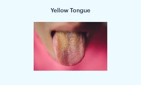 Image result for yellow tongue infection