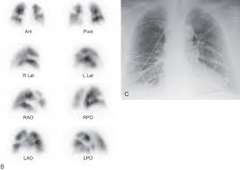 Image result for Ventilation Perfusion Scan