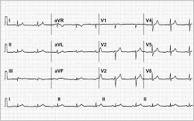 For suspected cases, consider consultation with cardiology for assistance with cardiac evaluation and management. Myocarditis With St Elevation And Elevated Cardiac Enzymes Misdiagnosed As An St Elevation Myocardial Infarction Journal Of Emergency Medicine