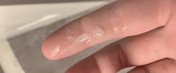 A thick white discharge that is itchy after ovulation is most likely to be a yeast infection. What Is Early Pregnancy Discharge Mommyhood101