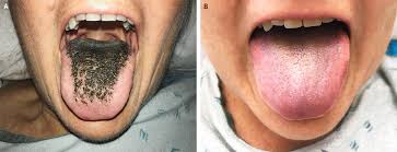 Image result for black tongue symptoms