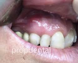Fistula En La Encia Que Es Y Tratamiento De La Fistula Dental