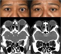 Early Experience With Teprotumumab For Chronic Thyroid Eye Disease Sciencedirect