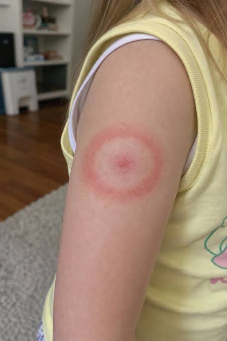 What causes a non-itchy, spreading red ring on a child's arm?