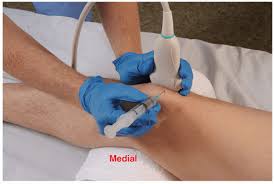 Image result for Prepatellar Bursa Injection