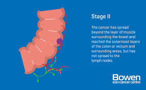 The national bowel cancer screening program (nbcsp) started in australia in 2006. What Is Bowel Cancer Bowel Cancer Explained Bowen Icon Cancer Centre