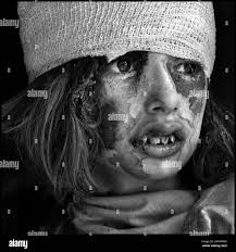 Iraq wounded hi-res stock photography and images