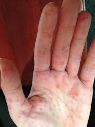 If you get a blistering. Rapidly Progressing Rash In An Adult Photo Quiz American Family Physician