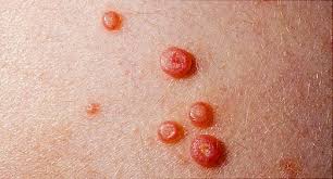 It doesn't strike everyone infected with syphilis who did not seek treatment, but it can happen. Rashes Bumps And Lumps Below The Belt