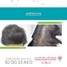وحدة زراعة الشعر في مستشفيات المانع