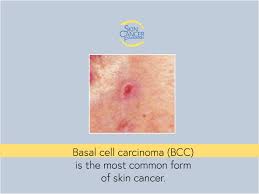 Alliance Cancer Care - How To Spot A Bcc: Five Warning Signs 1. An Open  Sore That Does Not Heal, And May Bleed, Ooze Or Crust. 2. A Reddish Patch  Or Irritated