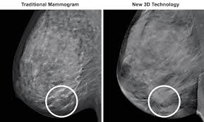 The jama paper looks at over 450,000 screenings between march previously i worked as a blood and cancer specialist. 3d Mammography Tm Medical Associates Of Northwest Arkansas