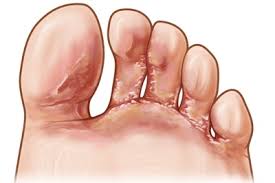 Layari www.doctoroncall.com.my untuk mengenali punca lain. Cara Merawat Kaki Makan Air Athletes Foot Dengan Berkesan Dan Semulajadi Serimuslimah Sihat