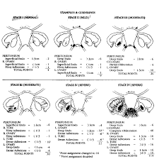 Endometriosis Obgyn Net