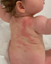 Image result for sweat rash on back baby