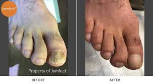 Image result for Toenail Removal