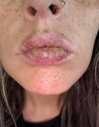 My 16 year old daughter been staying nights away at her boyfriend house for  the last 6 weeks she came back home with yellow stuff around her lips ..  What is it ☹️