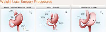 weight loss procedures gastric sleeve