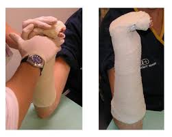 Image result for Ulnar Gutter Cast