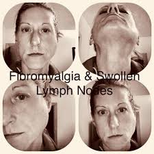 The Fibromyalgia