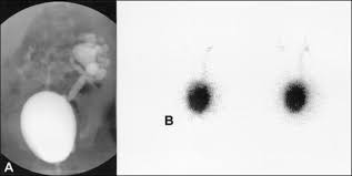 Reflux findings on vcug are graded on a scale from i to v (see table grades of vesicoureteral reflux of urine from the bladder into the ureter may cause bacterial infection of the upper urinary tract. Vesicoureteral Reflux American Academy Of Pediatrics