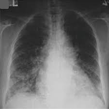 Image result for Hyperviscosity Syndrome