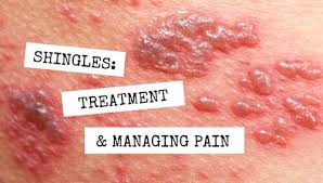 Image result for shingles