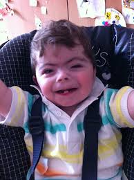 Cornelia de Lange syndrome