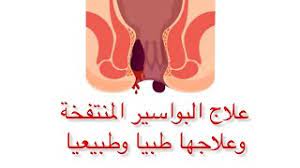 كيفية علاج البواسير الخارجية المنتفخة الملتهبة طبيعيا بالطب البدديل وطبيا وصفات علاج البواسير Youtube
